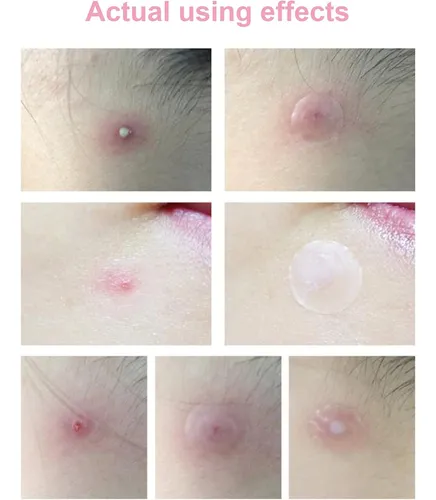 PARCHES ANTI-ACNE - Imagen 10